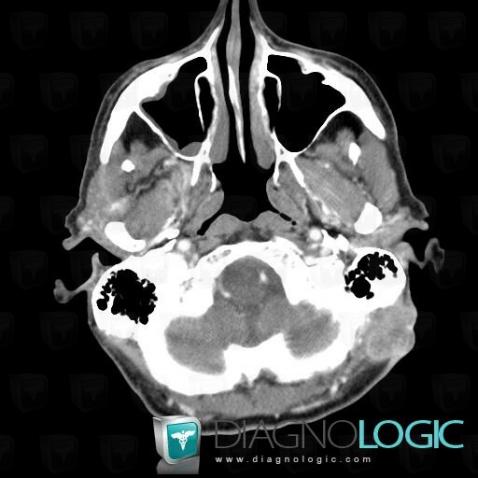 Cas radiologie : Carcinome épidermoïde (Scanner ,IRM) - Diagnologic