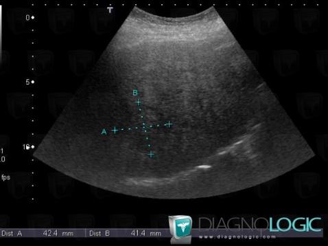 Carcinome hépatocellulaire, Foie, Echographie