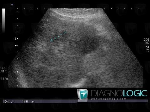Carcinome hépatocellulaire, Foie, Echographie