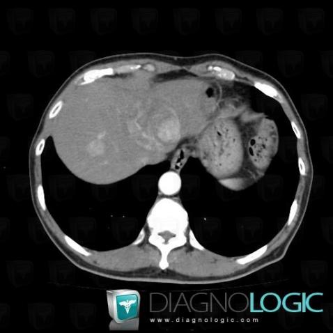 Carcinome hépatocellulaire, Foie, Scanner