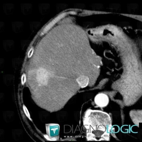 Carcinome hépatocellulaire, Foie, Scanner