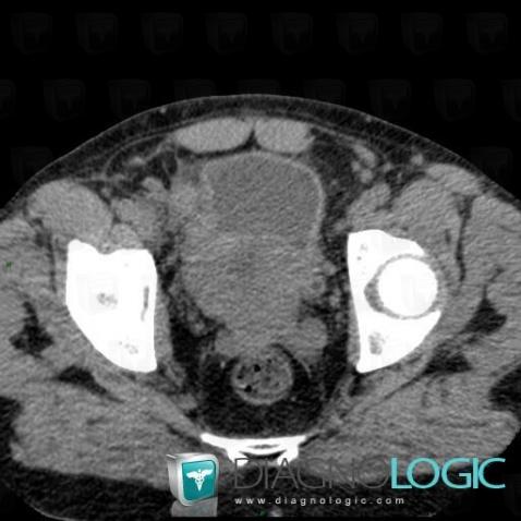 Carcinome vésical-cellules transitionnelles, Vessie, Scanner