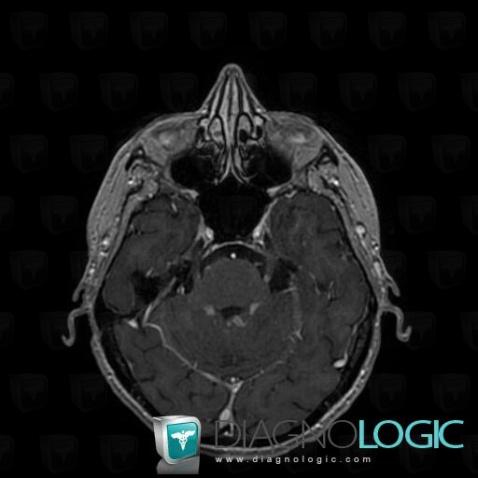 Carcinose méningée, Autres nerfs craniens, IRM