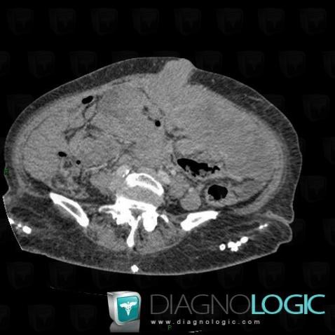 Carcinose péritonéale, Paroi abdominale, Scanner