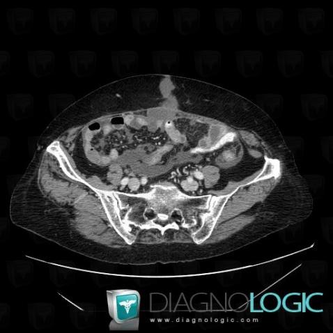 Carcinose péritonéale, Paroi abdominale, Scanner