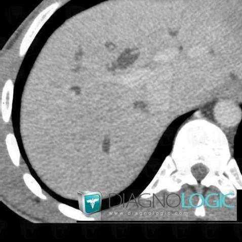 Caroli disease, Intra and extra hepatic bile ducts, CT