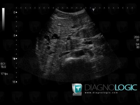 Caroli disease, Liver, Intra and extra hepatic bile ducts, US