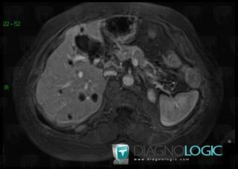 Caroli disease, Liver, MRI