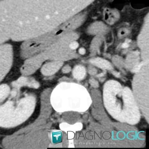 Castleman disease, Retroperitoneum, CT