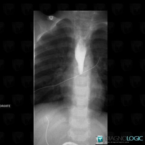 Caustic esophagitis, Oesophagus, X rays