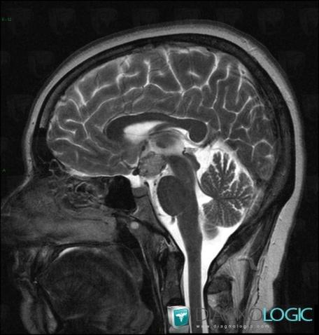 Cavernome, Faux-cerveau / Ligne médiane, Hypophyse et région parasellaire, IRM