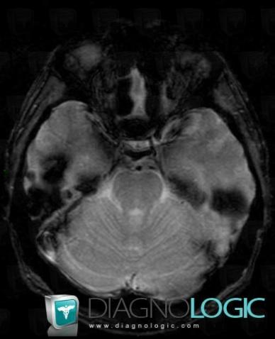 Cas radiologie Cavernome (IRM) Diagnologic