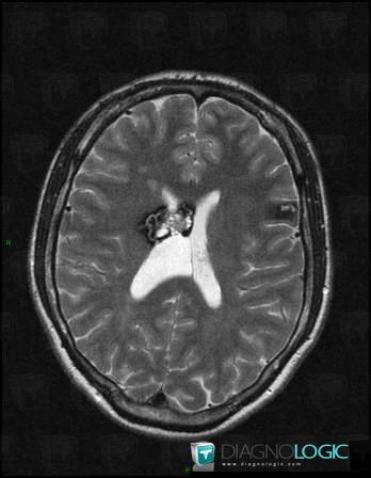Cavernome, Région cortico sous corticale, Hémisphères cérébraux, IRM