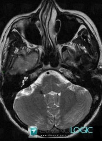 Cavernous angioma, Brainstem, MRI