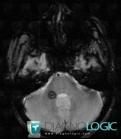 Cavernous angioma, Brainstem, MRI