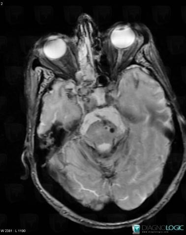 Cavernous angioma, Brainstem, MRI