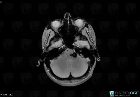 Cavernous angioma, Brainstem, MRI