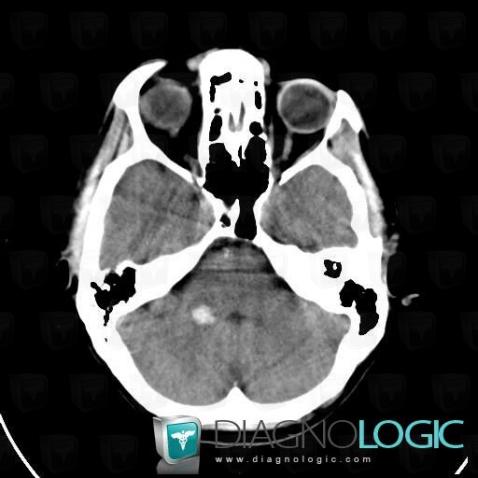 Cavernous angioma, Brainstem, Posterior fossa, CT