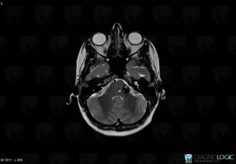 Cavernous angioma, Brainstem, Posterior fossa, MRI