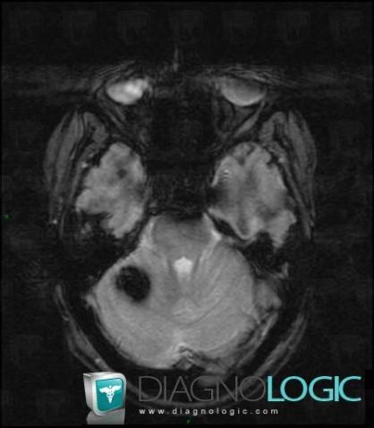 Cavernous angioma, Cerebellar hemisphere, MRI