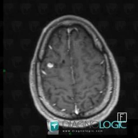 Cavernous angioma, Cerebral hemispheres, MRI