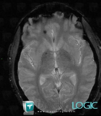 Cavernous angioma, Cerebral hemispheres, MRI
