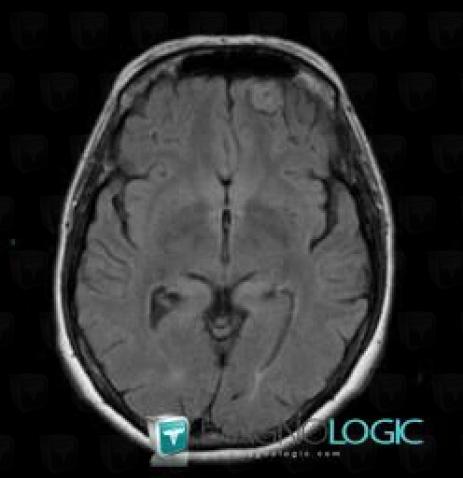 Cavernous angioma, Cerebral hemispheres, MRI