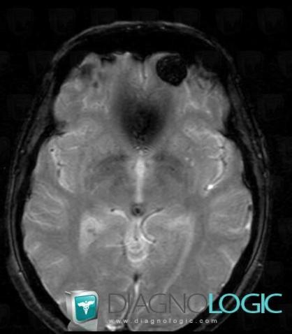 Cavernous angioma, Cerebral hemispheres, MRI