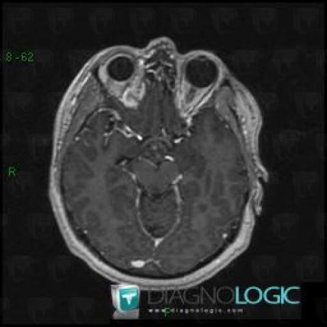 Cavernous angioma, Cerebral hemispheres, MRI