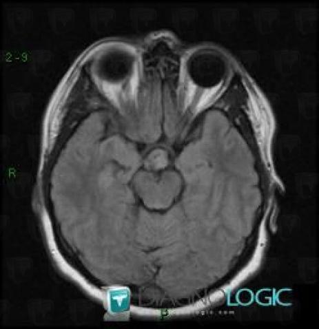 Cavernous angioma, Cerebral hemispheres, MRI