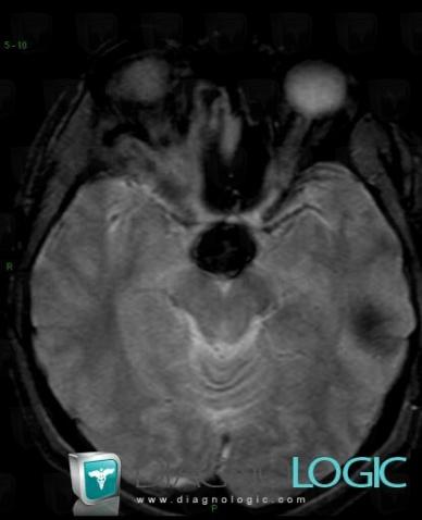 Cavernous angioma, Cerebral hemispheres, MRI