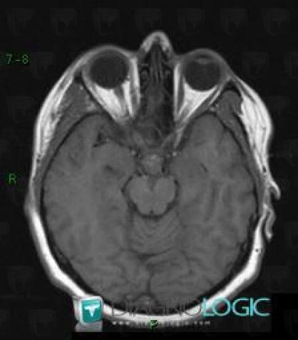 Cavernous angioma, Cerebral hemispheres, Pituitary gland and parasellar region, MRI