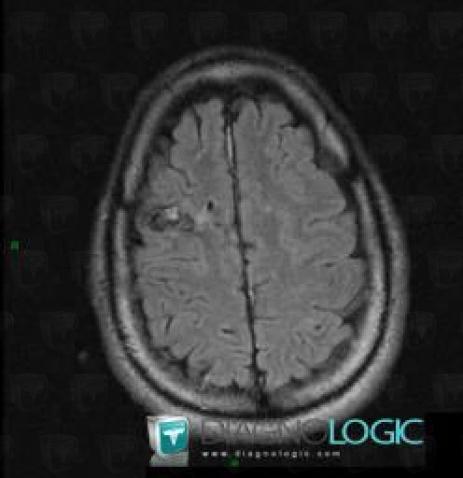 Cavernous angioma, Cortico subcortical region, Cerebral hemispheres, MRI
