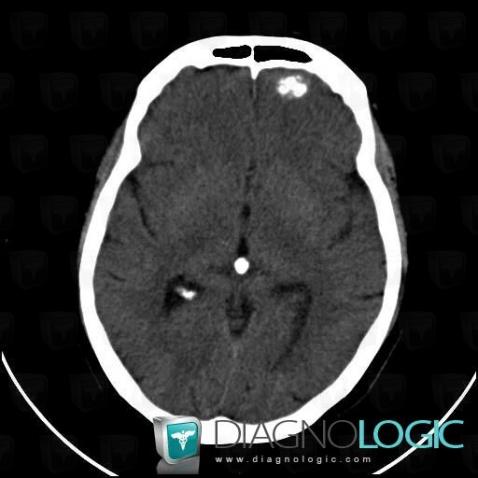 Cavernous angioma, Cortico subcortical region, CT