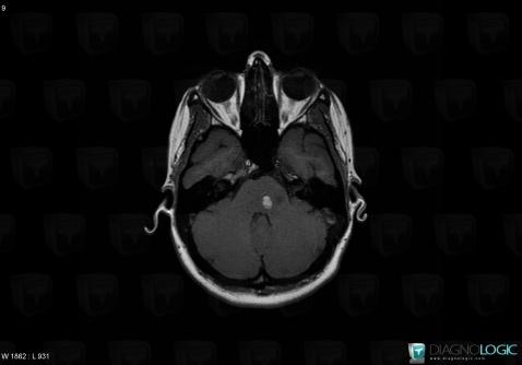 Cavernous angioma, Posterior fossa, MRI