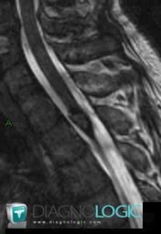 Cavernous angioma, Spinal canal / Cord, MRI