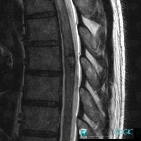 Cavernous angioma, Spinal canal / Cord, MRI