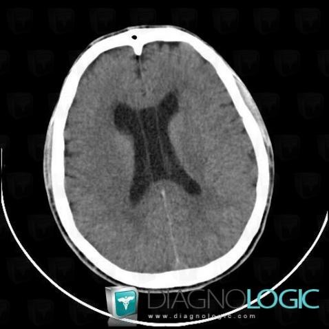 Cavum septi pellucidi, Cerebral hemispheres, CT