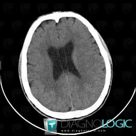 Cavum septi pellucidi, Cerebral hemispheres, Ventricles / Periventricular region, CT