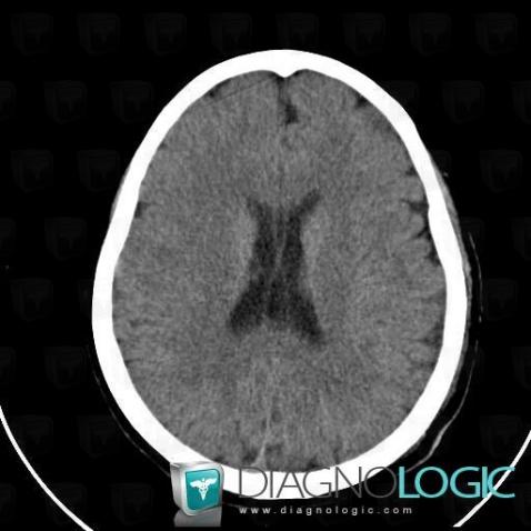 Cavum septi pellucidi, Cerebral hemispheres, Ventricles / Periventricular region, CT