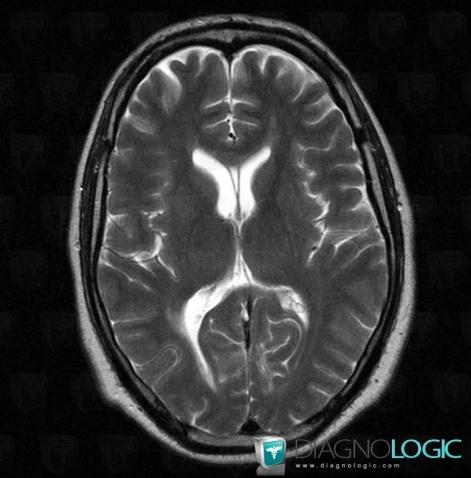 Cavum septi pellucidi, Cerebral hemispheres, Ventricles / Periventricular region, MRI