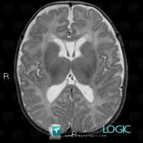 Cavum septi pellucidi, Cerebral hemispheres, Ventricles / Periventricular region, MRI