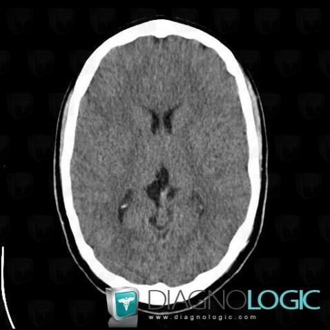 Cavum veli interpositi, Cerebral hemispheres, Cerebral falx / Midline, CT