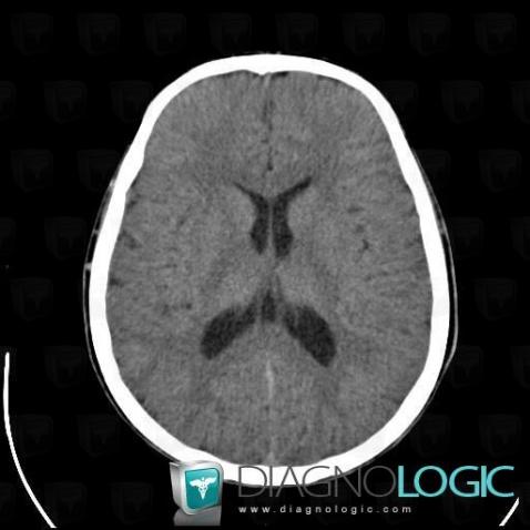Cavum veli interpositi, Cerebral hemispheres, Cerebral falx / Midline, CT