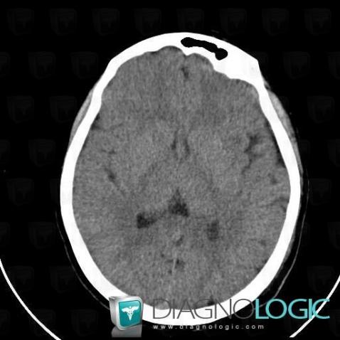 Cavum veli interpositi, Cerebral hemispheres, Cerebral falx / Midline, CT