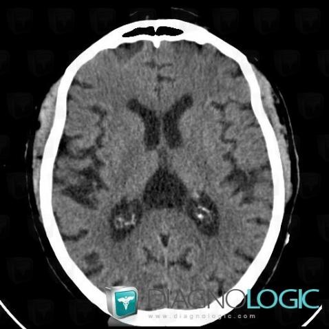 Cavum veli interpositi, Cerebral hemispheres, Ventricles / Periventricular region, CT