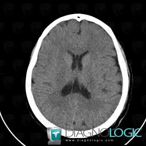 Cavum vergae, Cerebral hemispheres, V4 and vermis, Theoretical