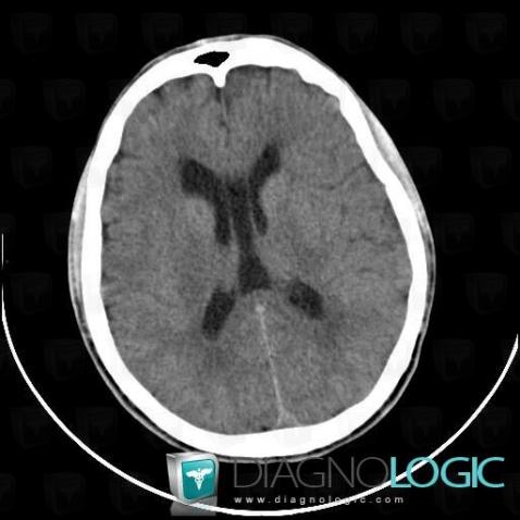 Cavum vergae, Cerebral hemispheres, Ventricles / Periventricular region, CT