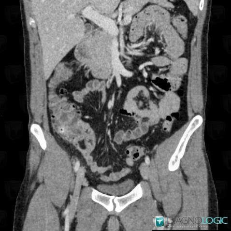 Cecal diverticulitis, Caecum / Appendix, Colon, CT