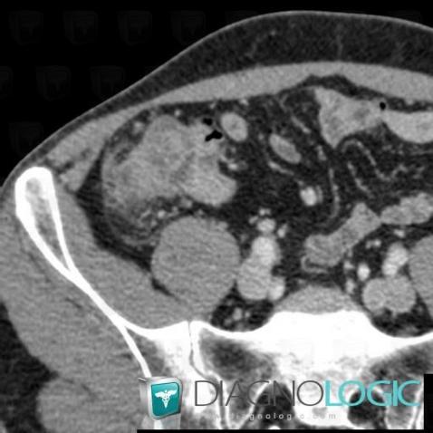 Cecal diverticulitis, Caecum / Appendix, CT